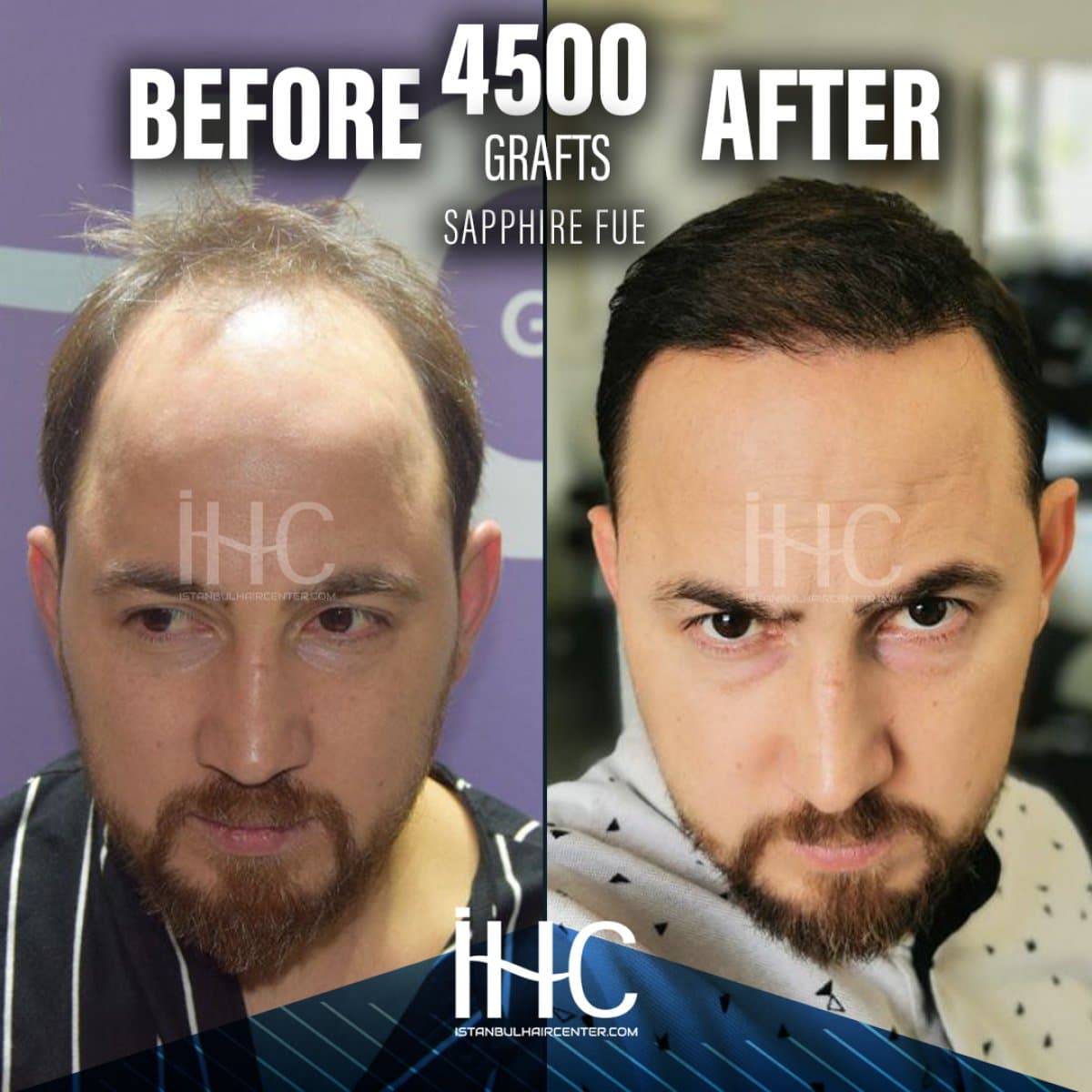 4500 grafts Sapphire FUE hair transplant