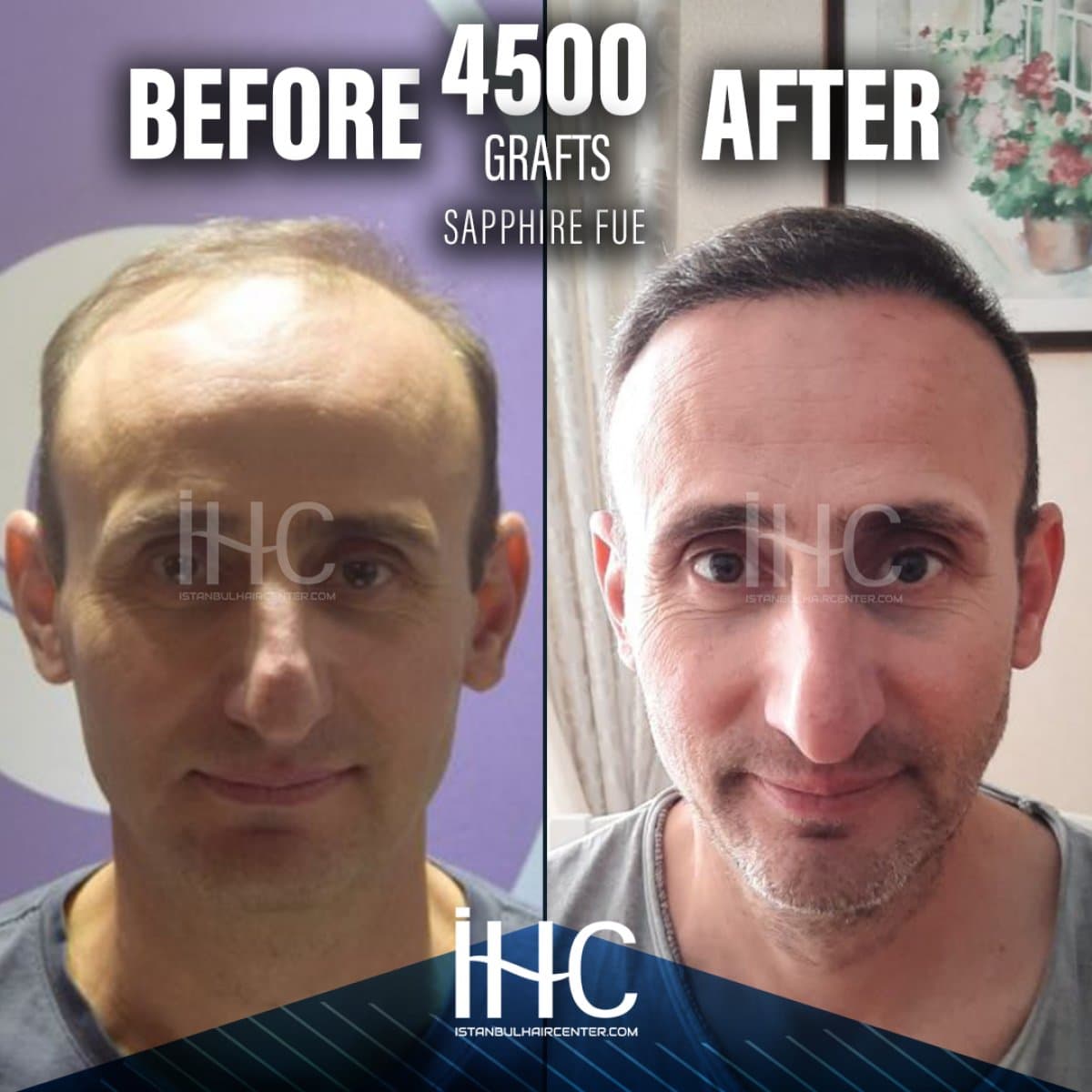 result of 4500 grafts Sapphire FUE hair transplant
