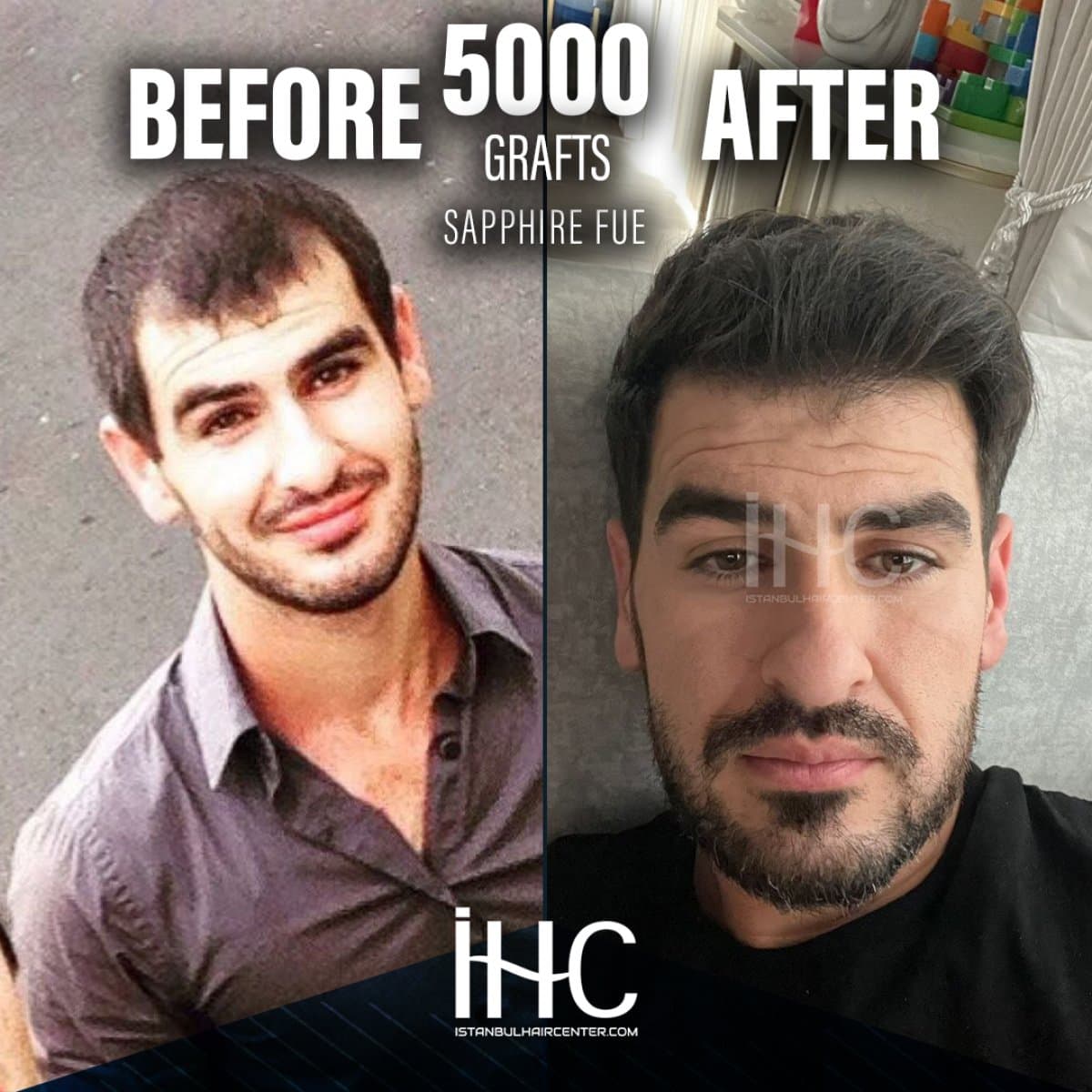 result of 5000 grafts Sapphire FUE hair transplant