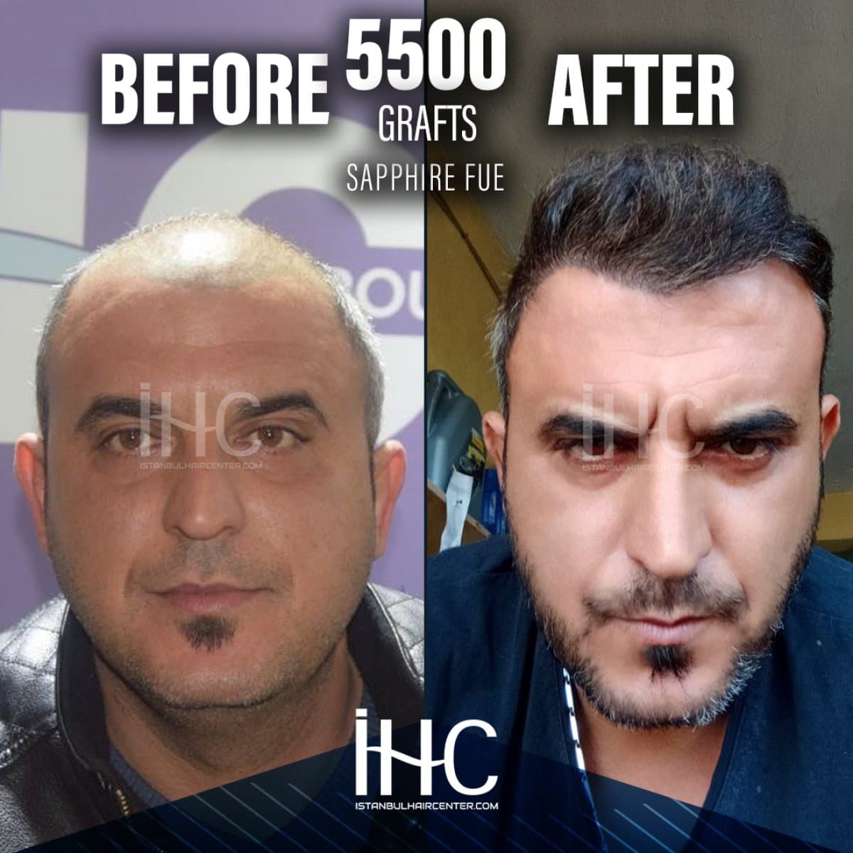 result of 5500 grafts Sapphire FUE hair transplant
