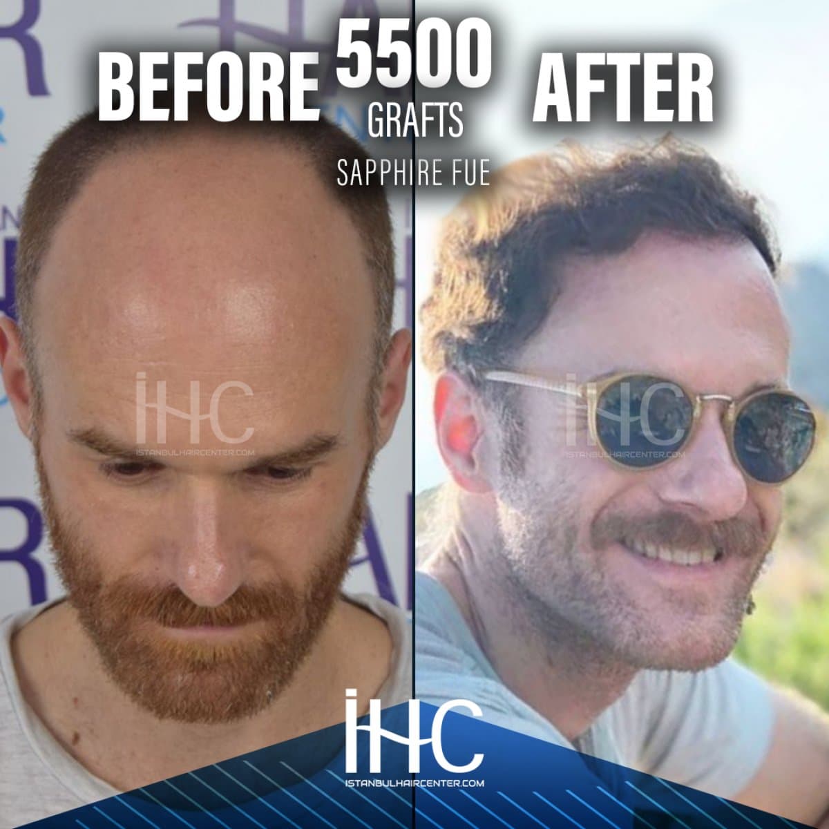5500 grafts Sapphire FUE hair transplant