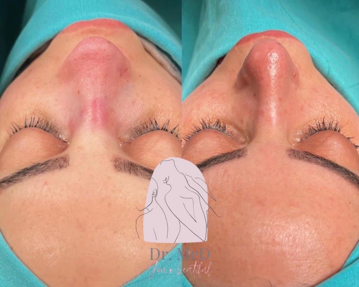 rhinoplasty