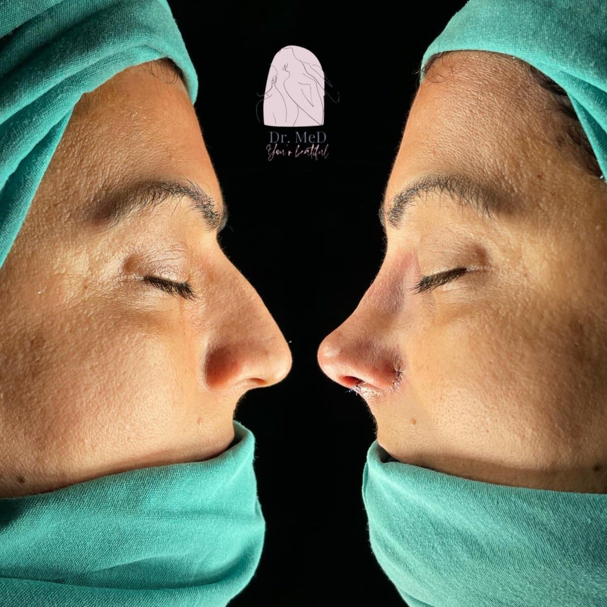 rhinoplasty