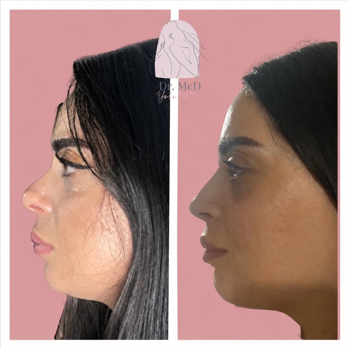 rhinoplasty