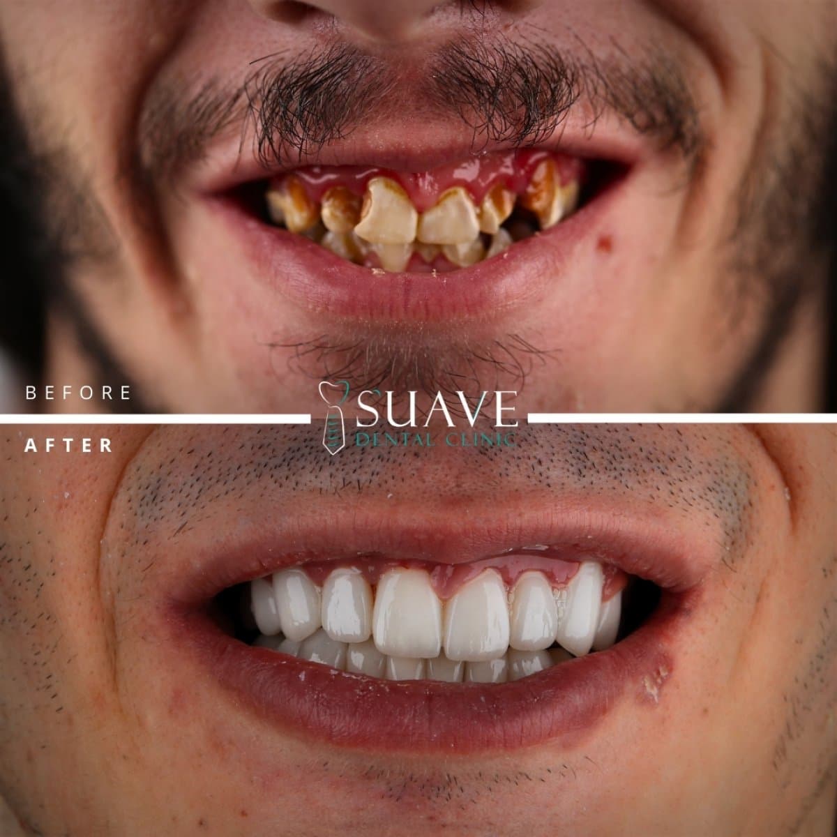 root canal treatment