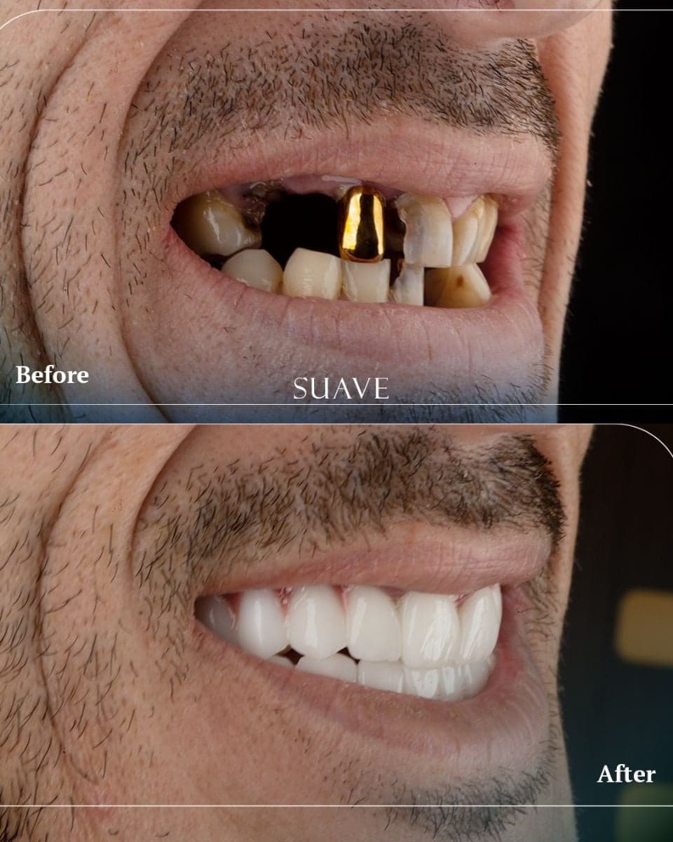 root canal treatment