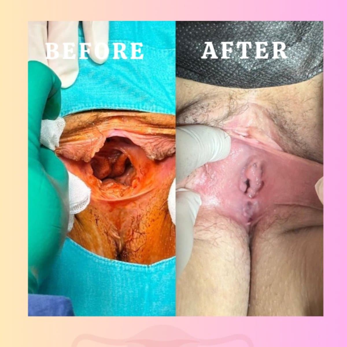 vaginal tightening