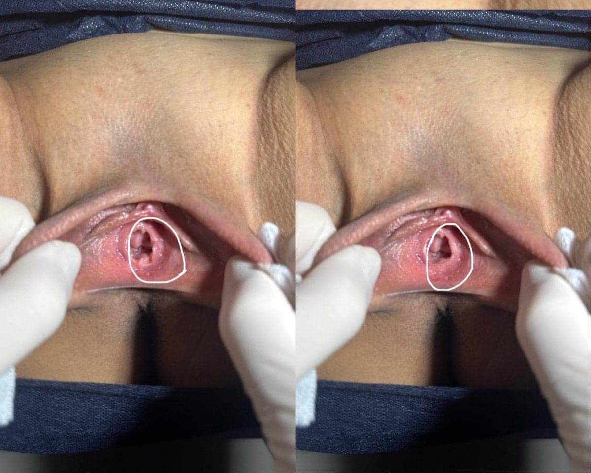 laser vaginal rejuvenation