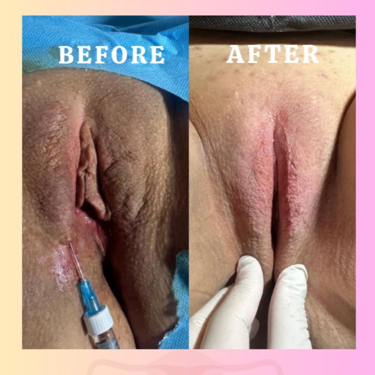 vaginal laser tightening
