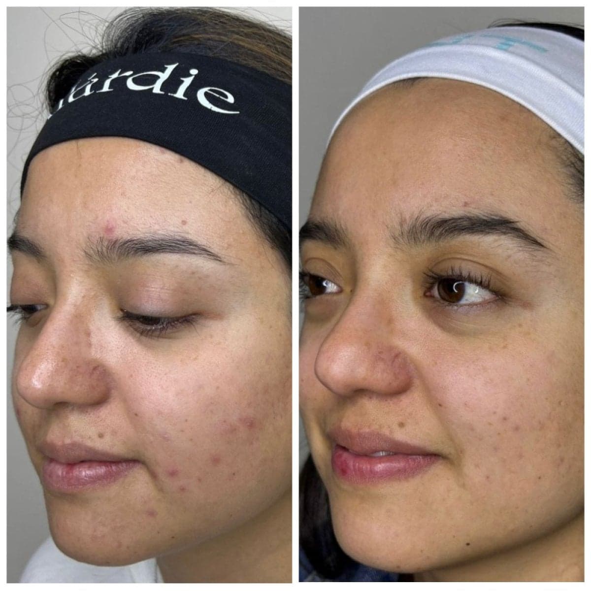 chemical peel