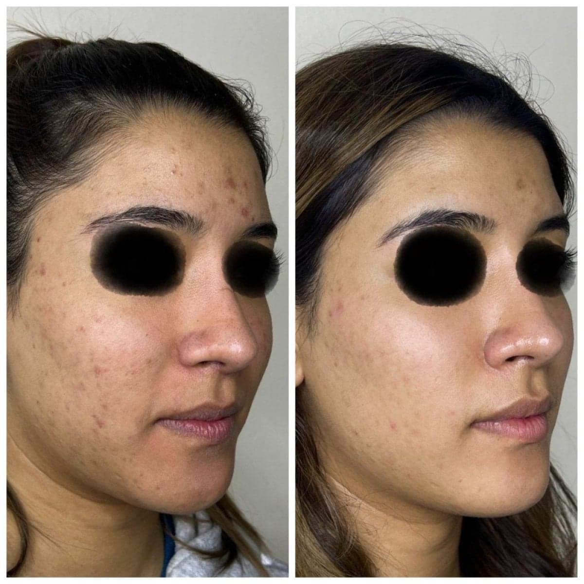 chemical peel