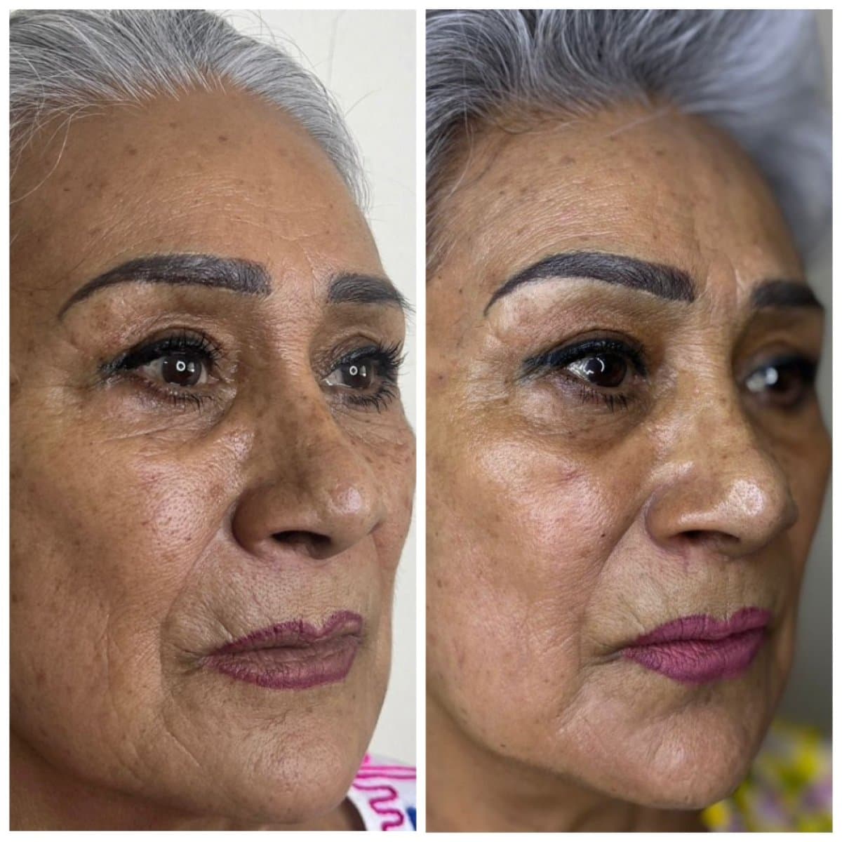chemical peel