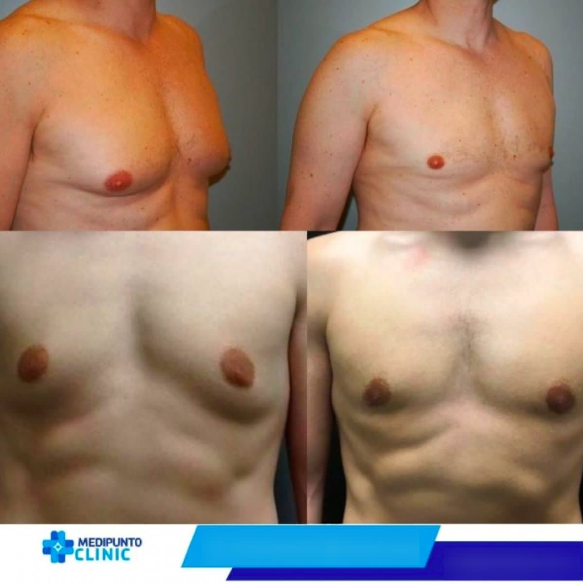 gynecomastia surgery