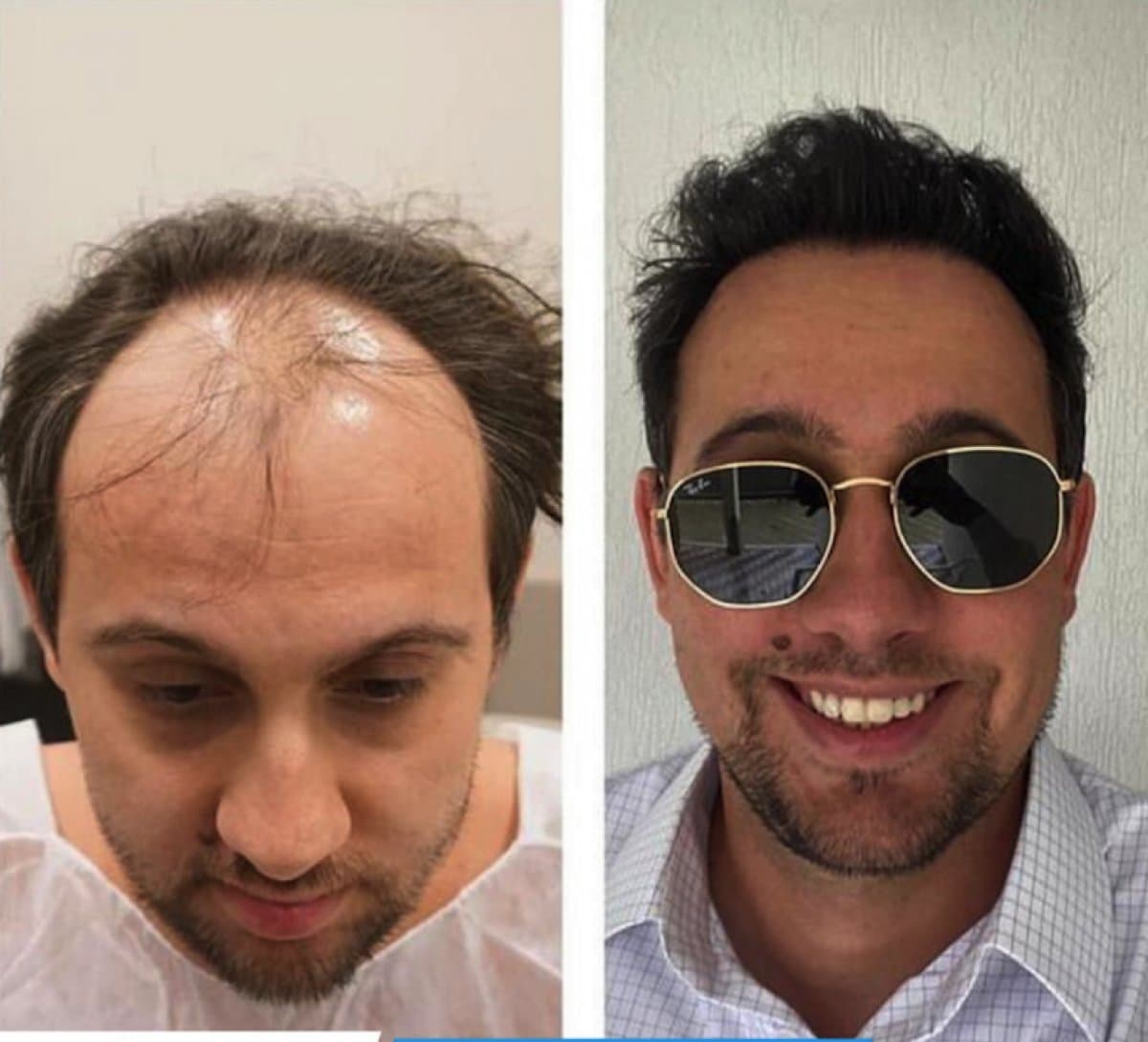 FUE hair transplant