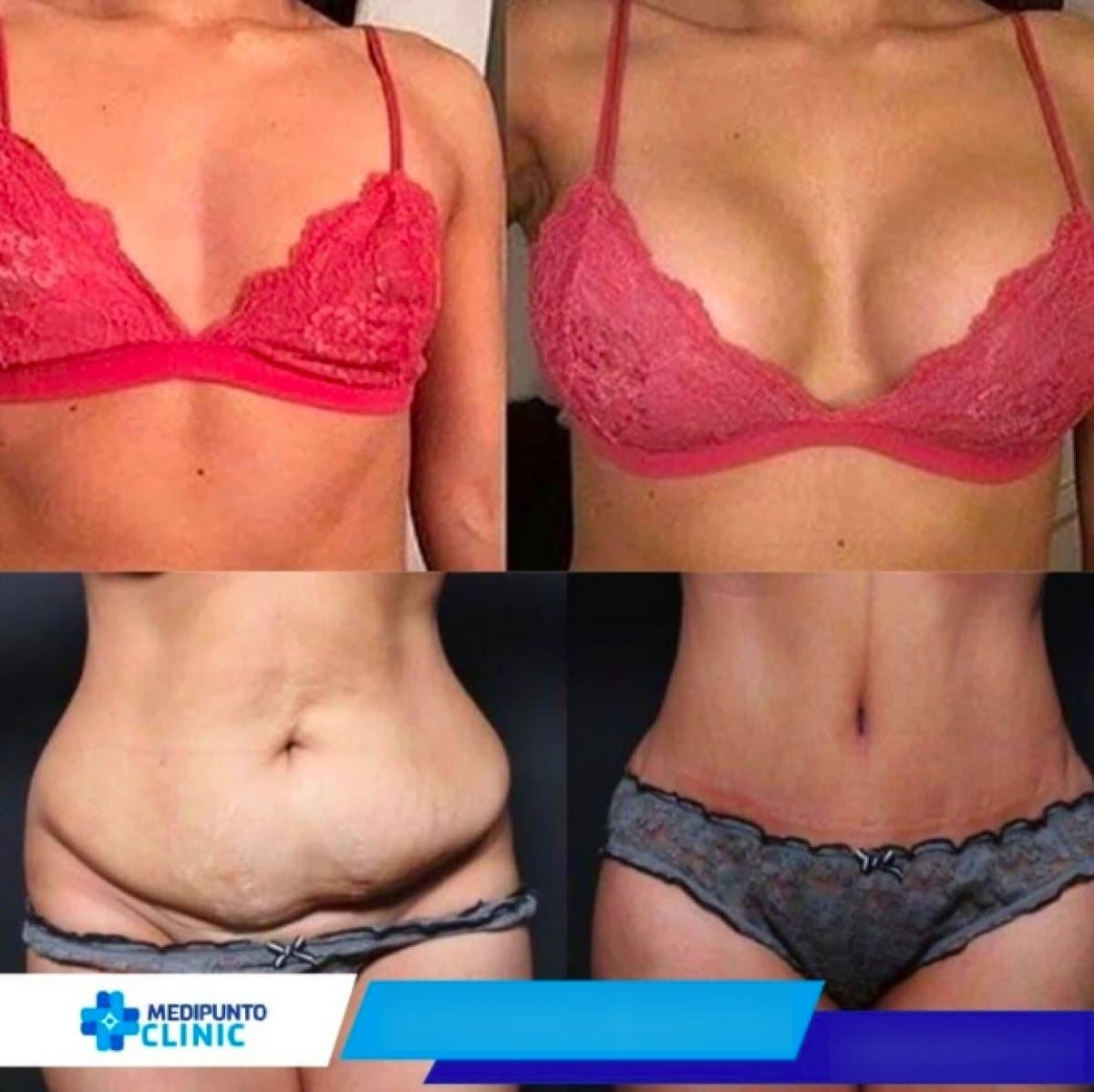 tummy tuck and breast augmentation