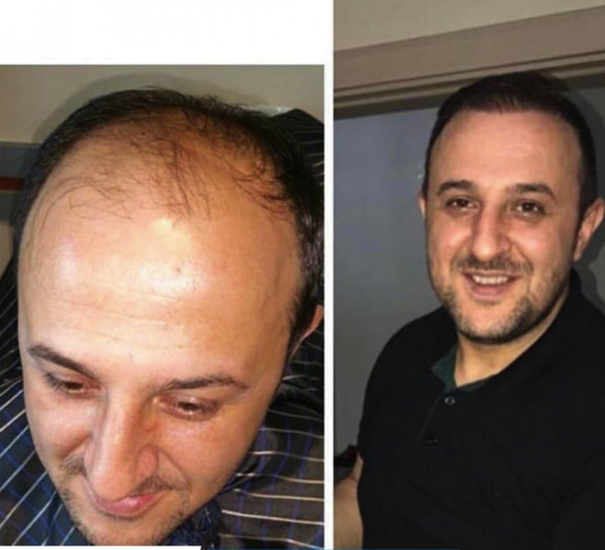 DHI hair transplant