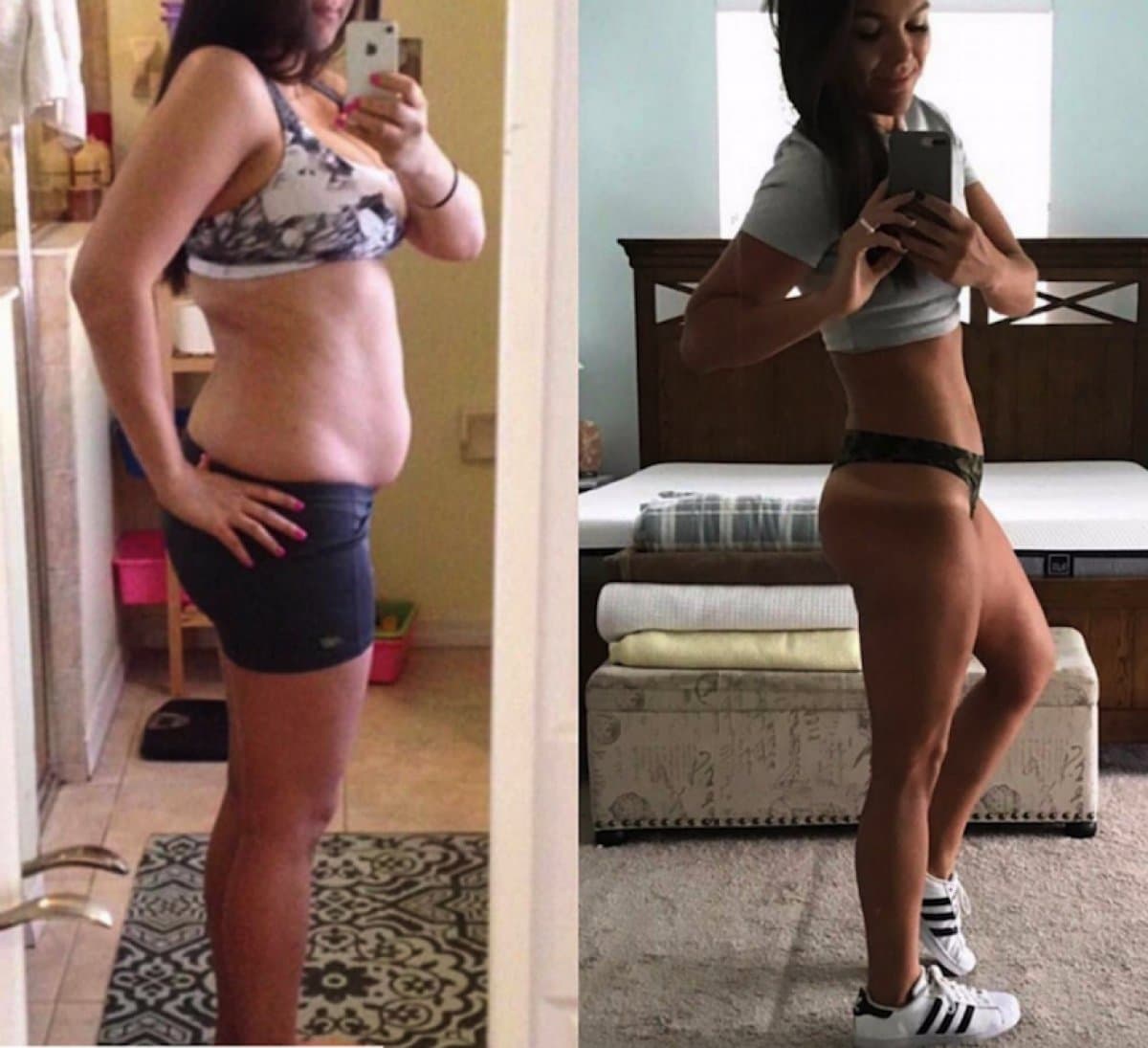 liposuction