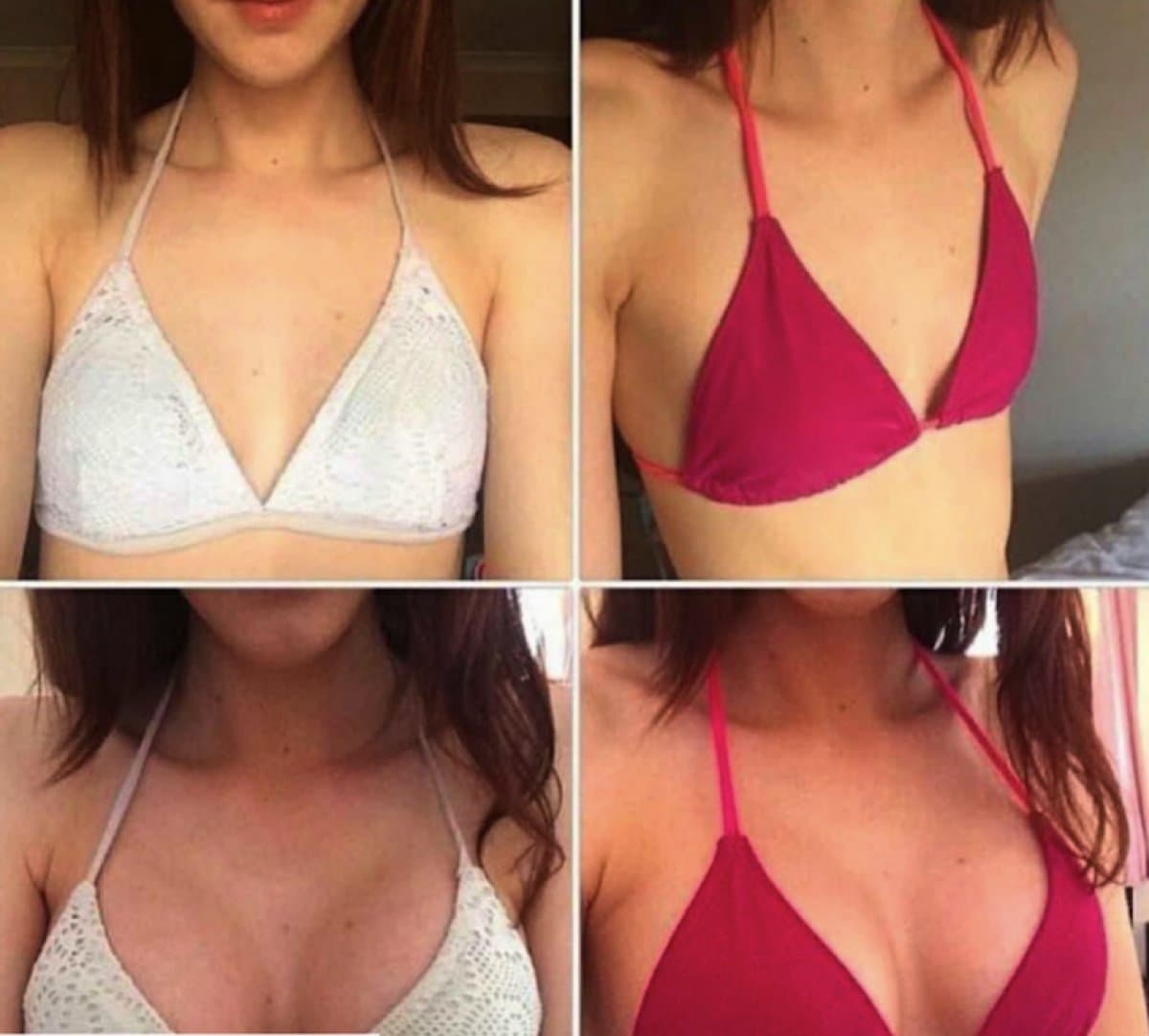 breast augmentation