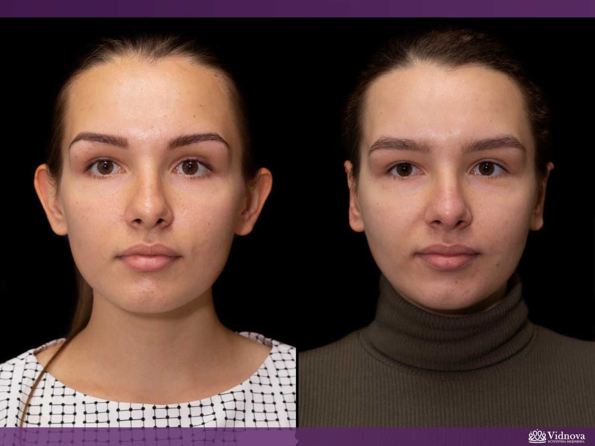 otoplasty