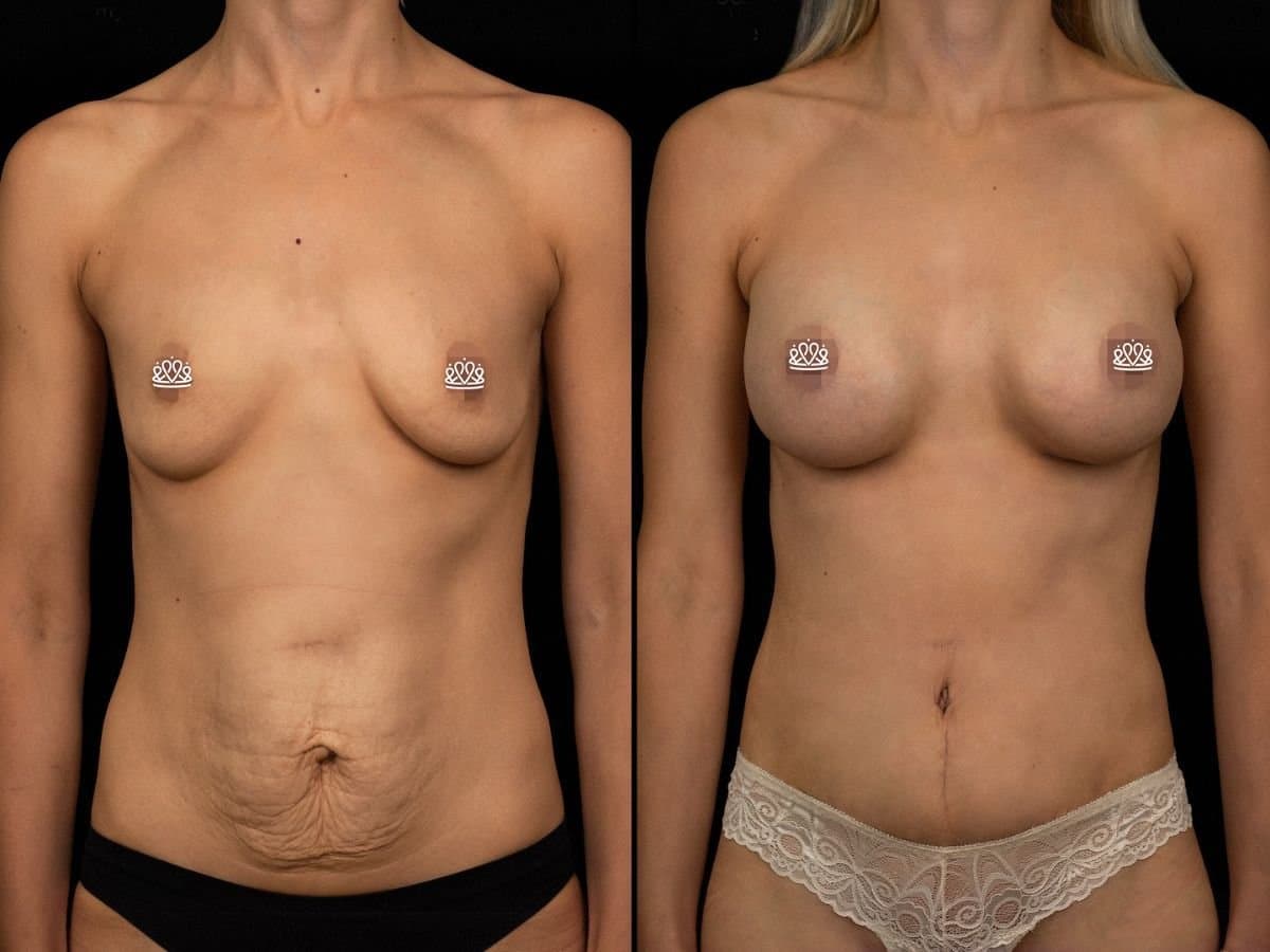 tummy tuck and breast augmentation