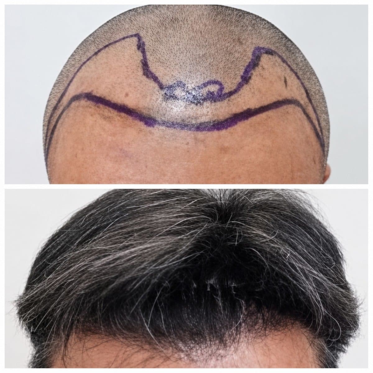 FUE hair transplant