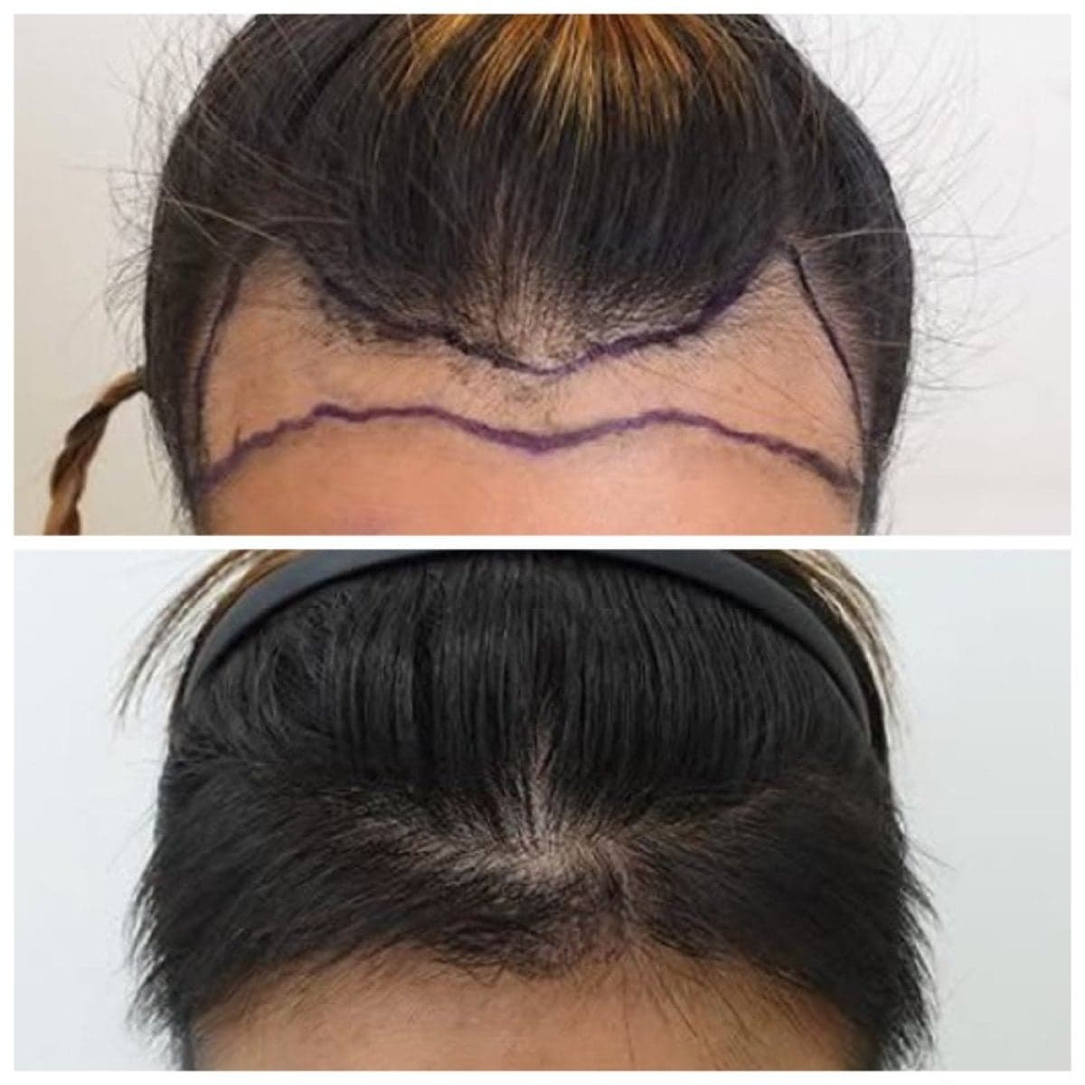 hair transplant