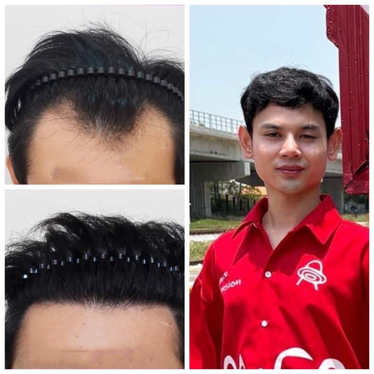hair transplant