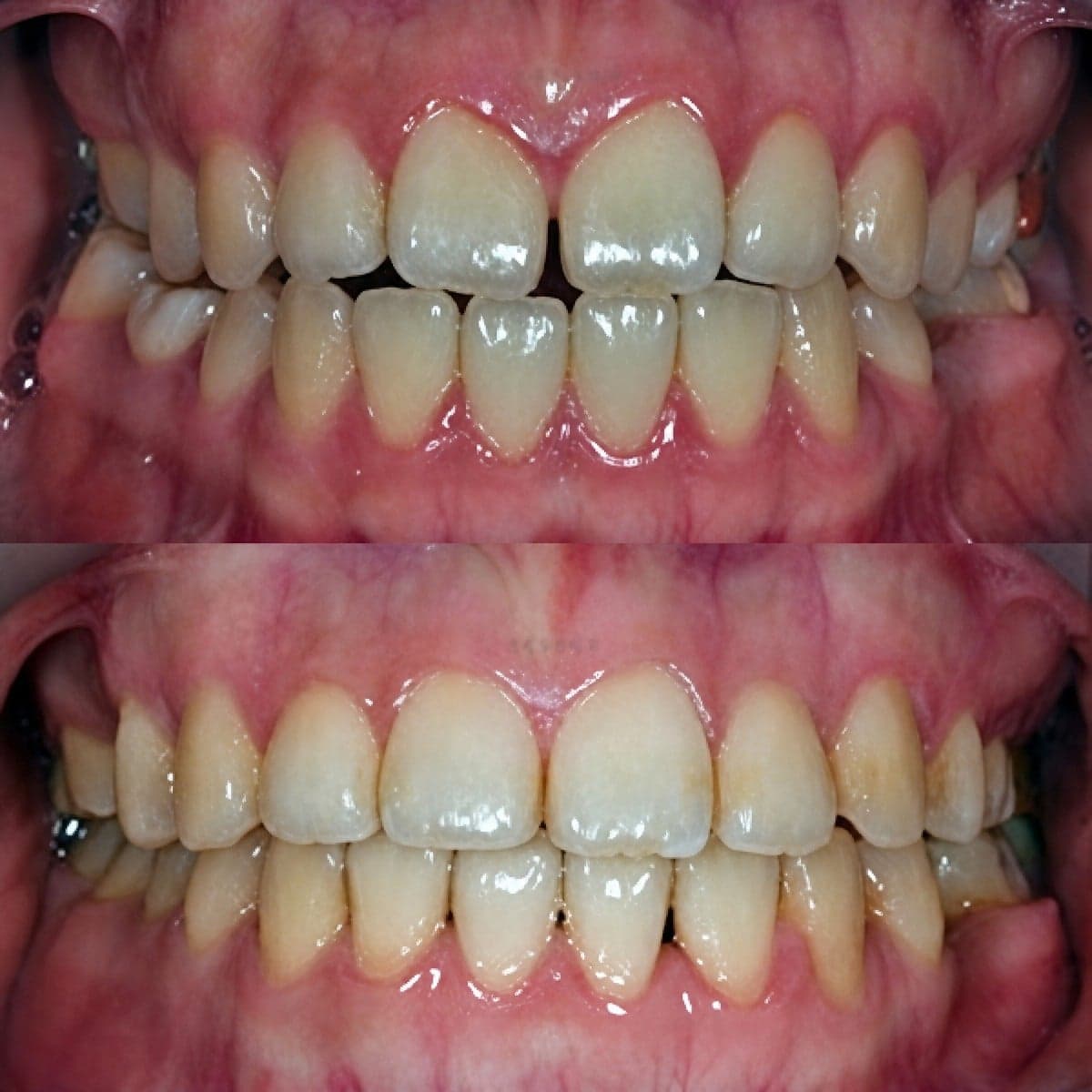 braces