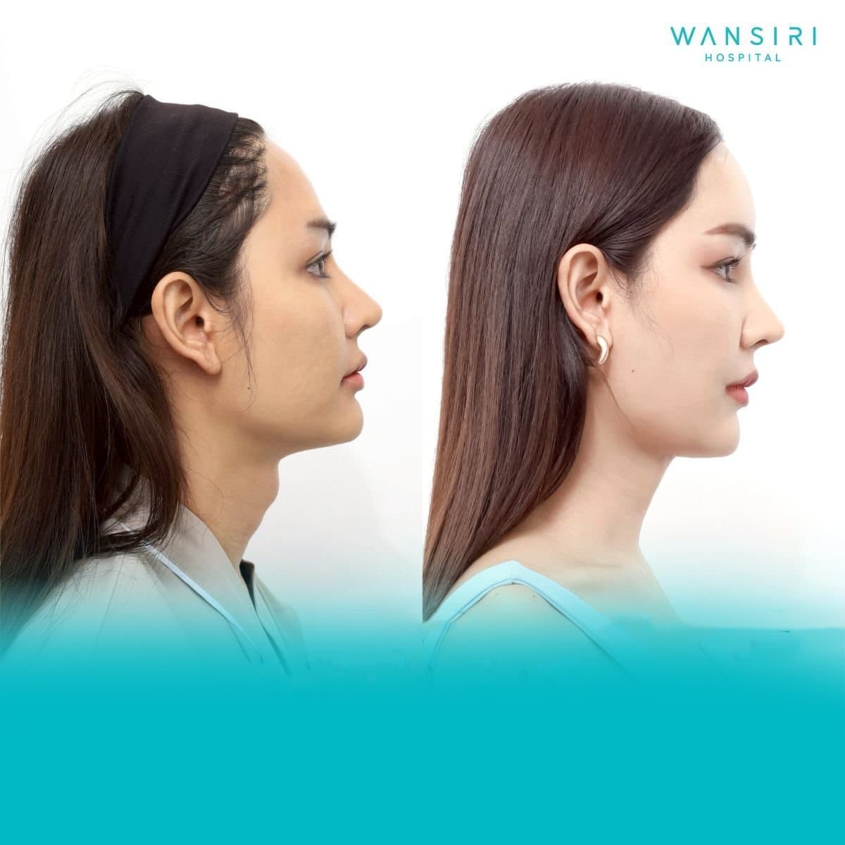 facial feminization surgery