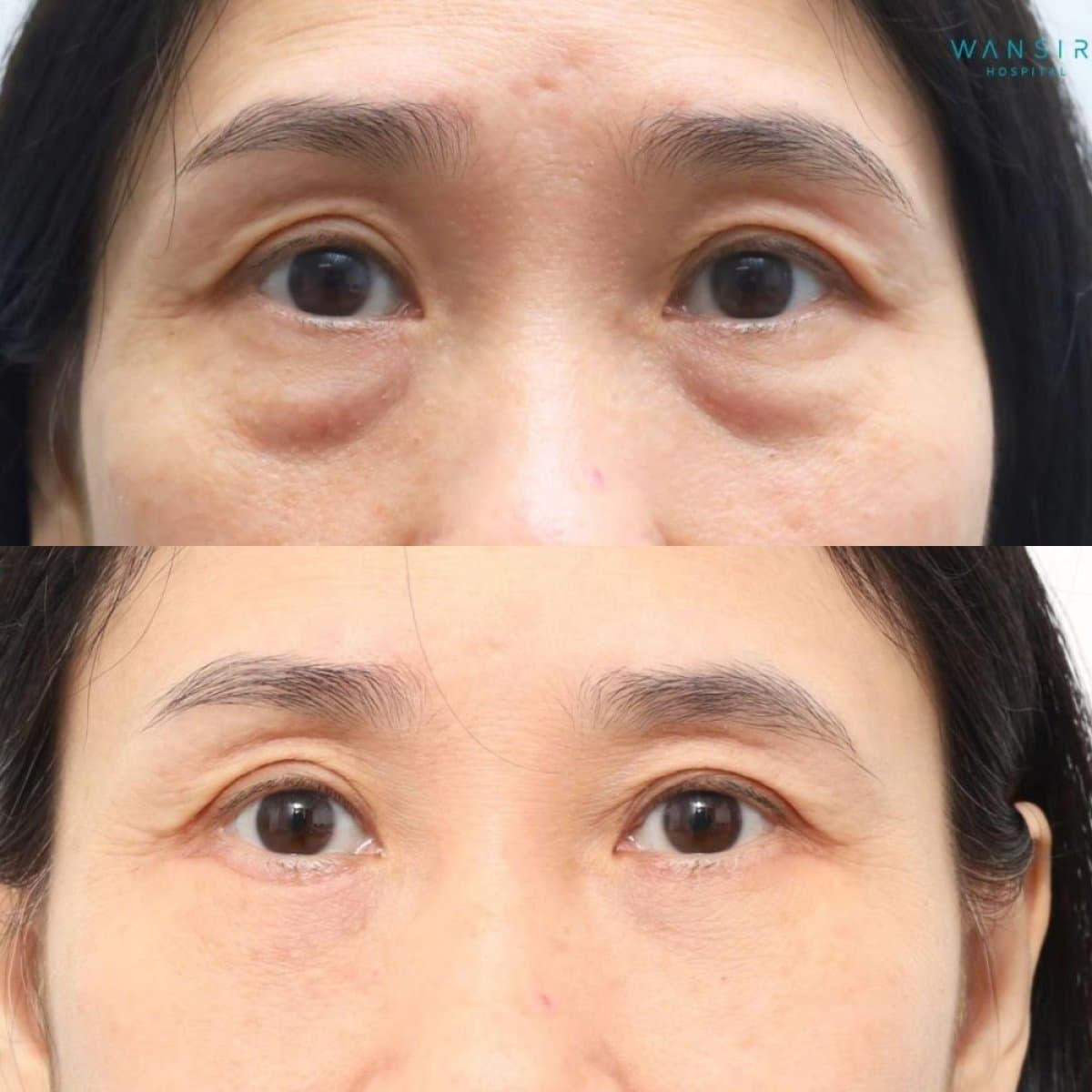upper and lower eyelid surgery