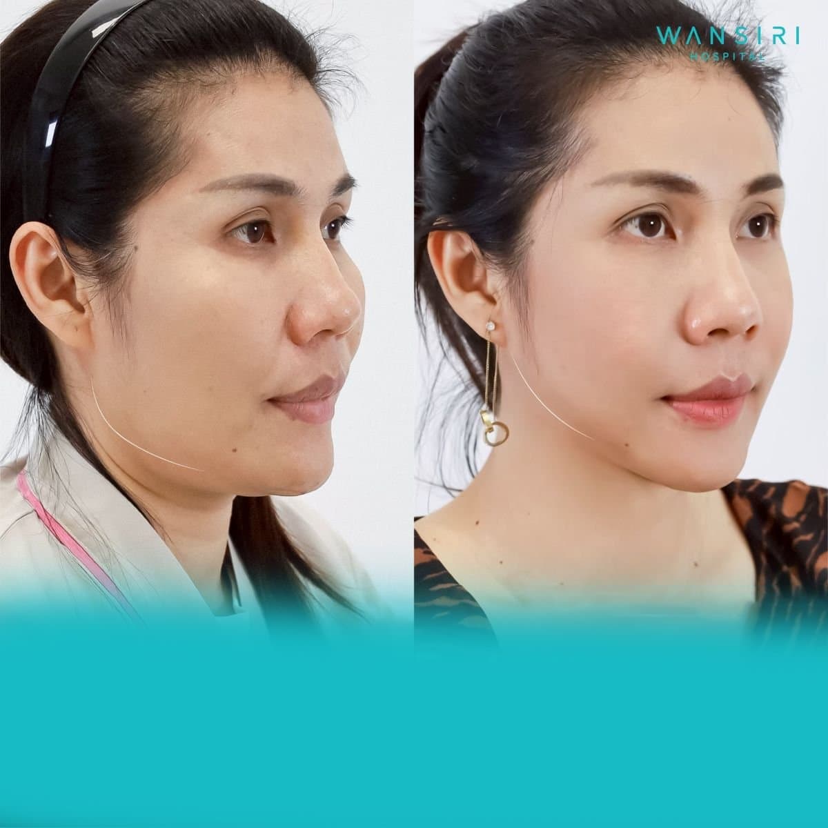 jaw shaping