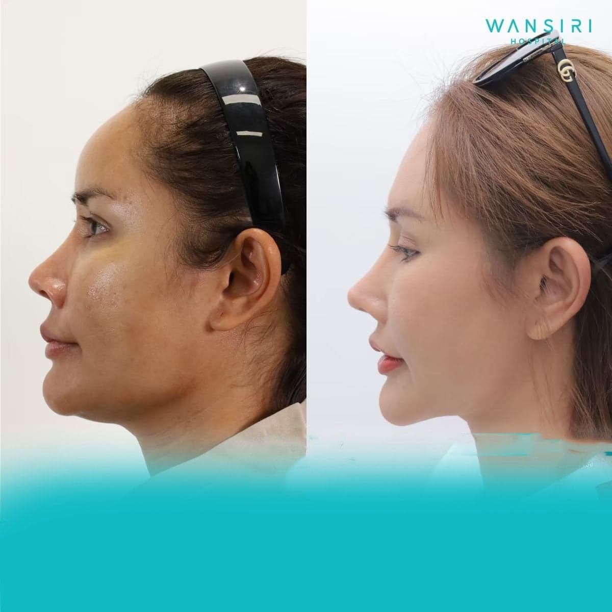 rhinoplasty