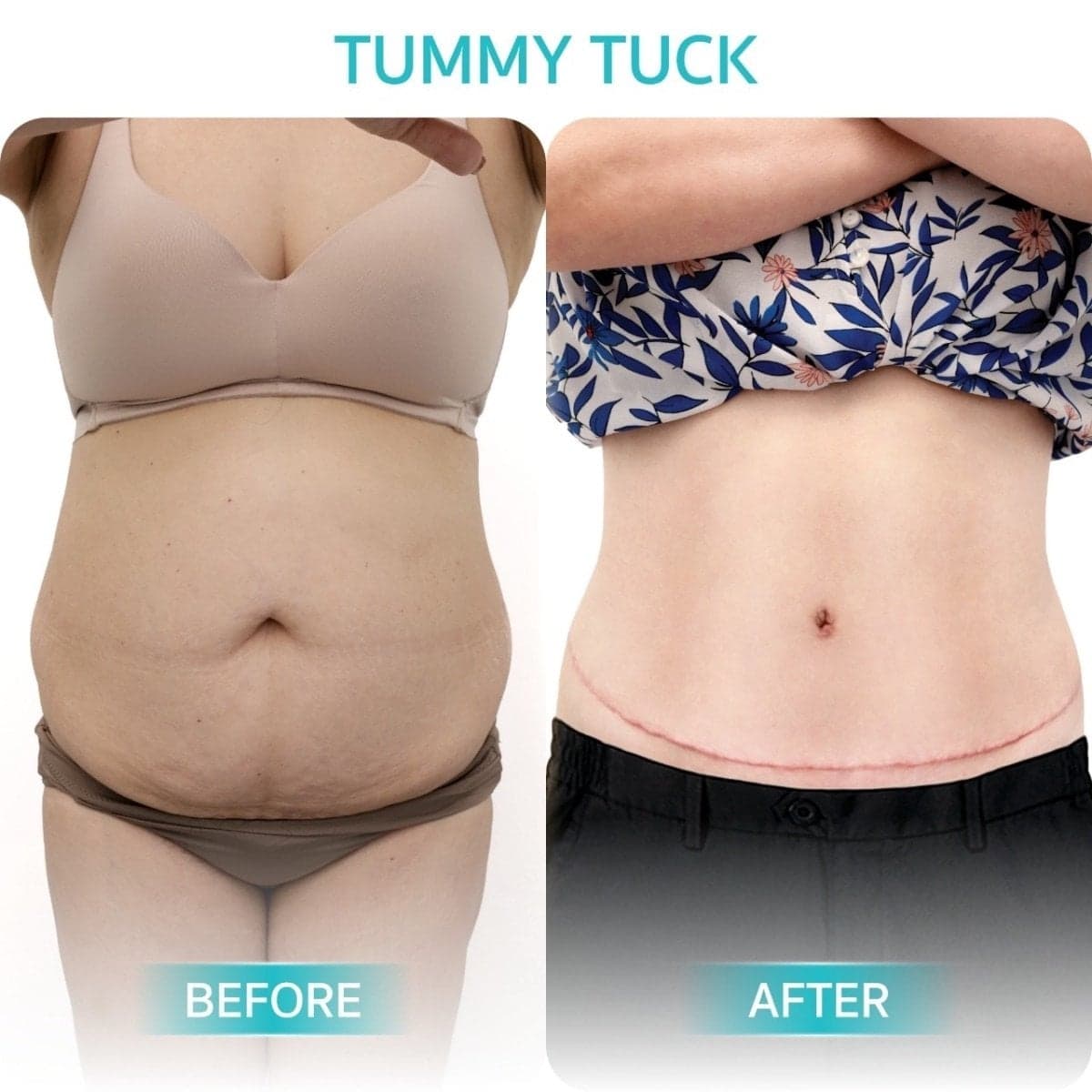 tummy tuck