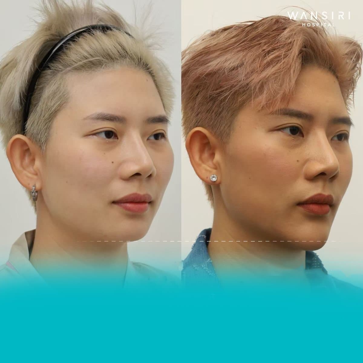 chin implant
