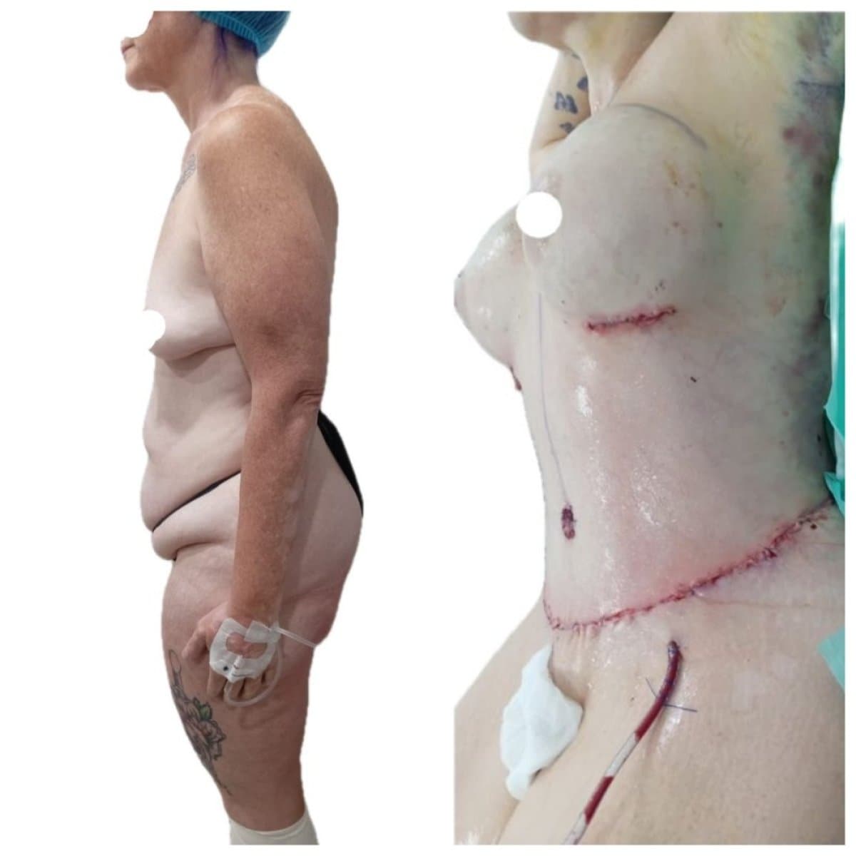 tummy tuck