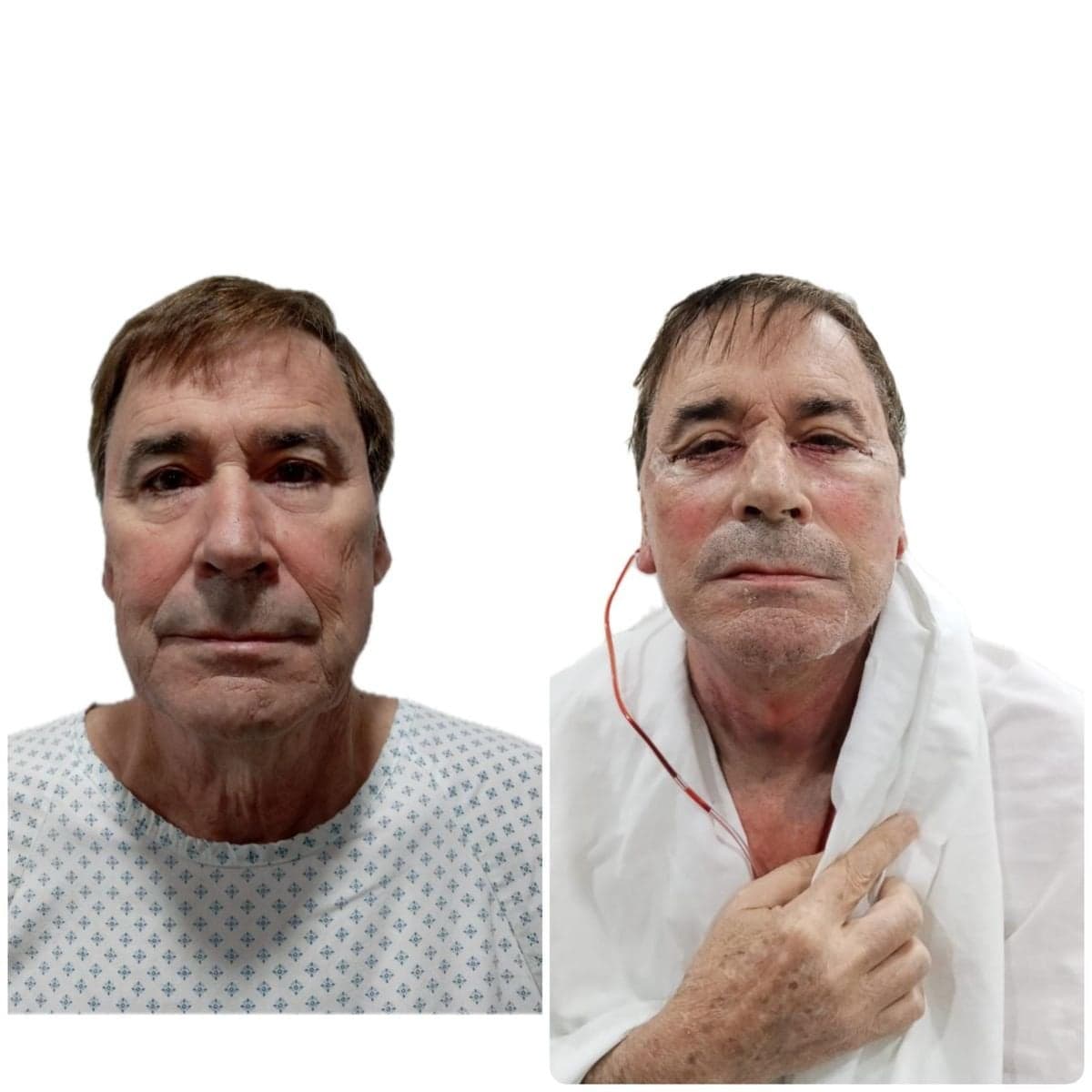facelift