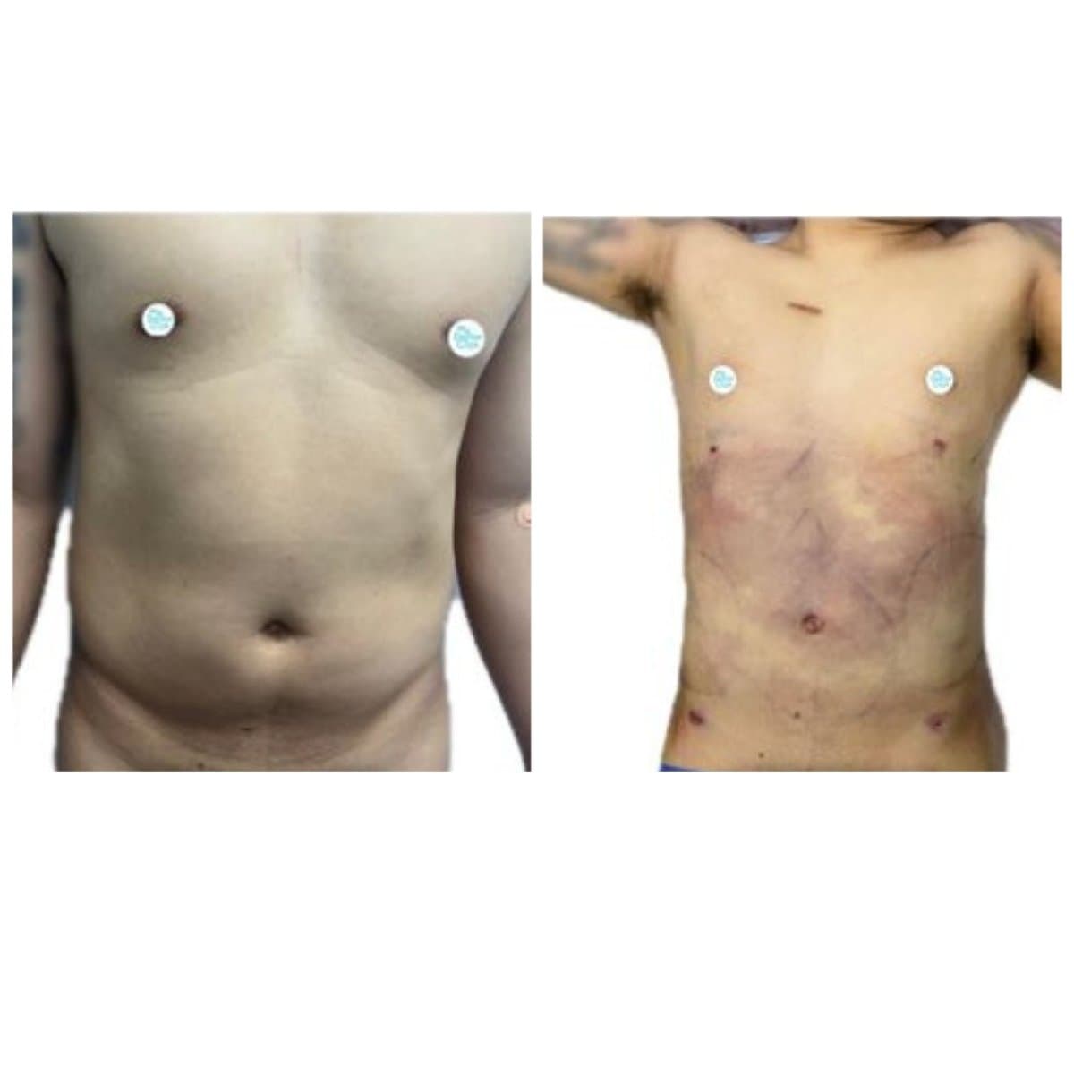 liposuction