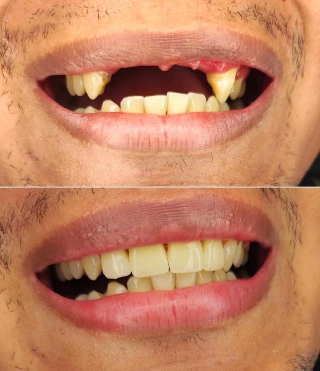 All-on-6 dental implants