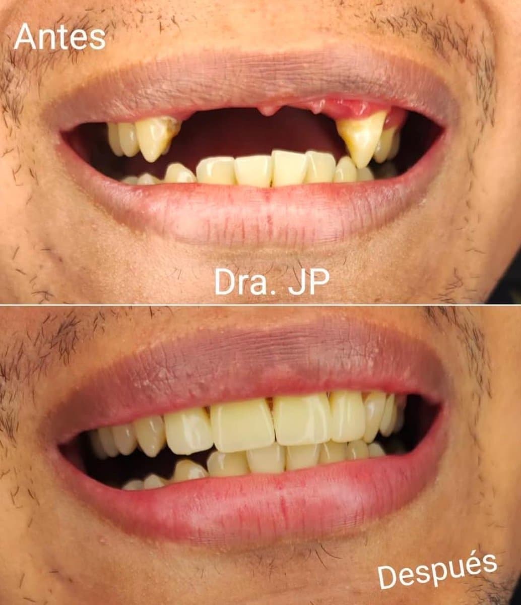 aesthetic temporary prosthesis