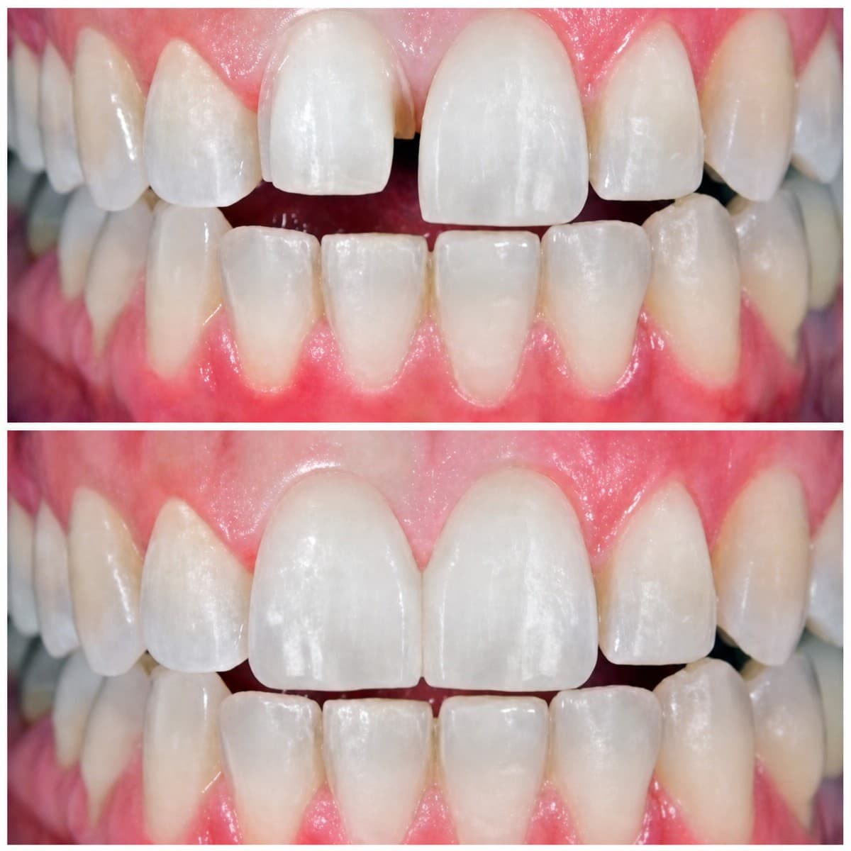 veneers