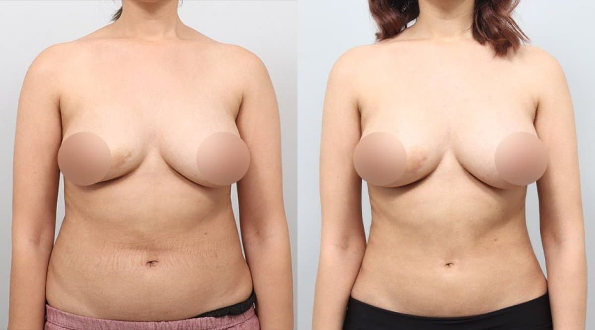 BodyTite body contouring