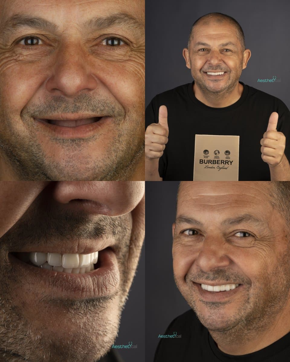 zygomatic implant