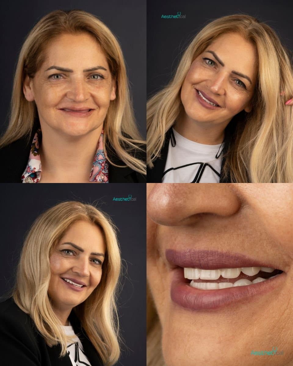 Zygomatic All-on-2 implants