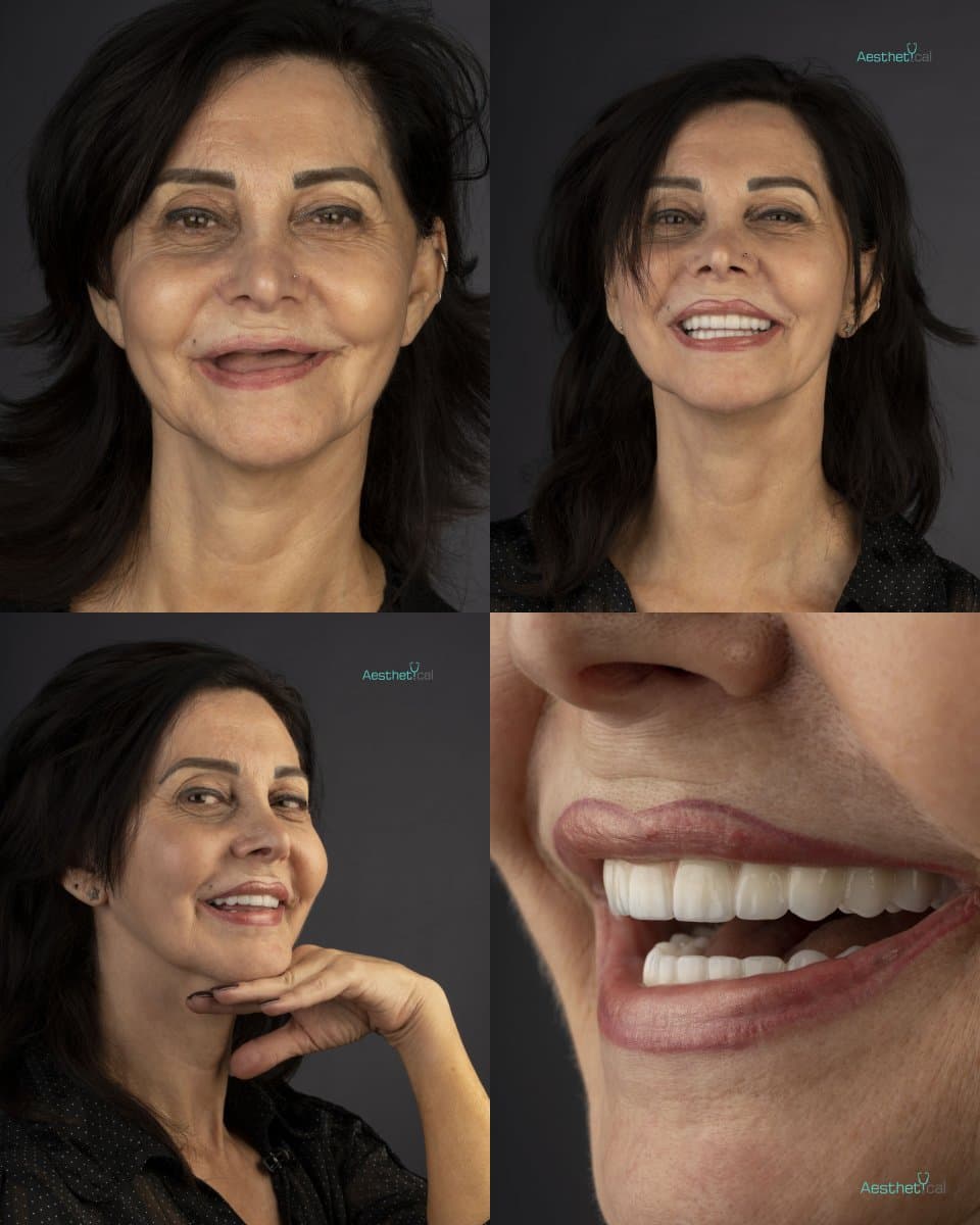 All-on-4 dental implants