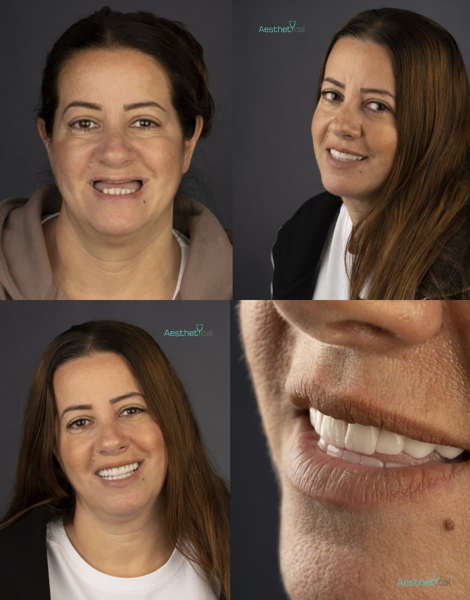 dental implant