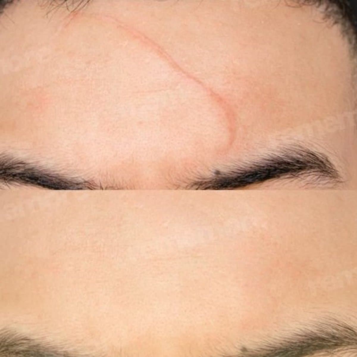 scar revision