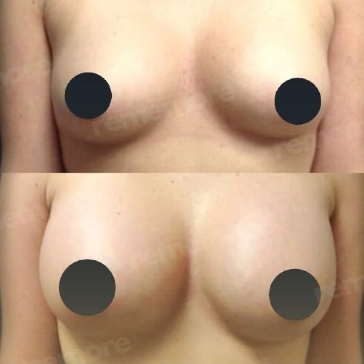 breast implant revision
