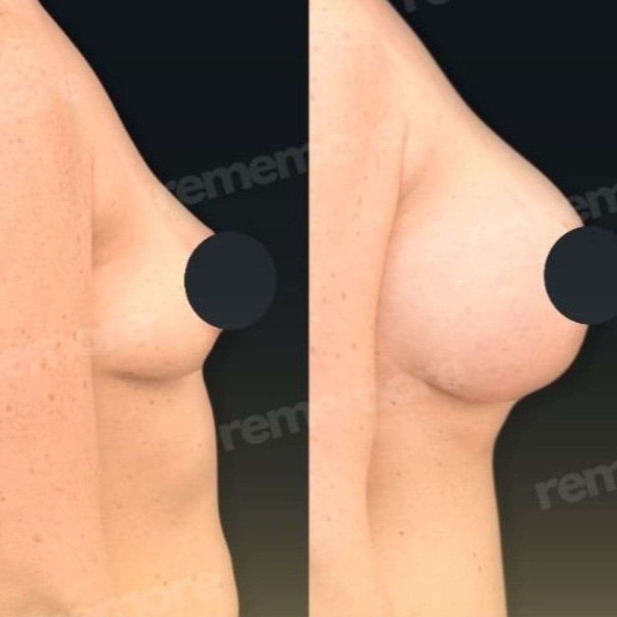 breast augmentation with fat transfer