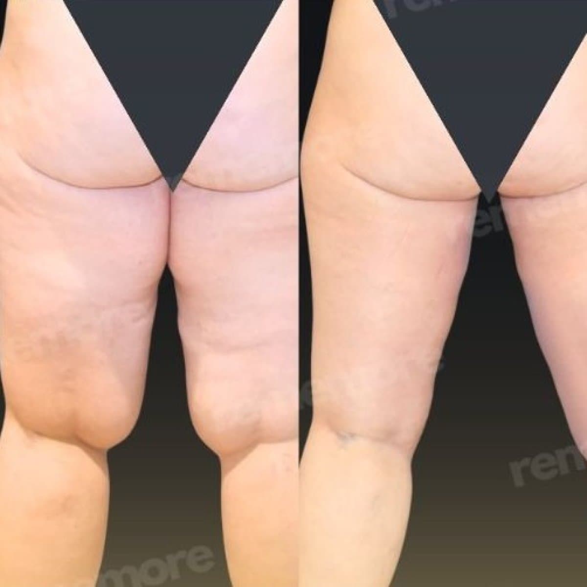 liposuction