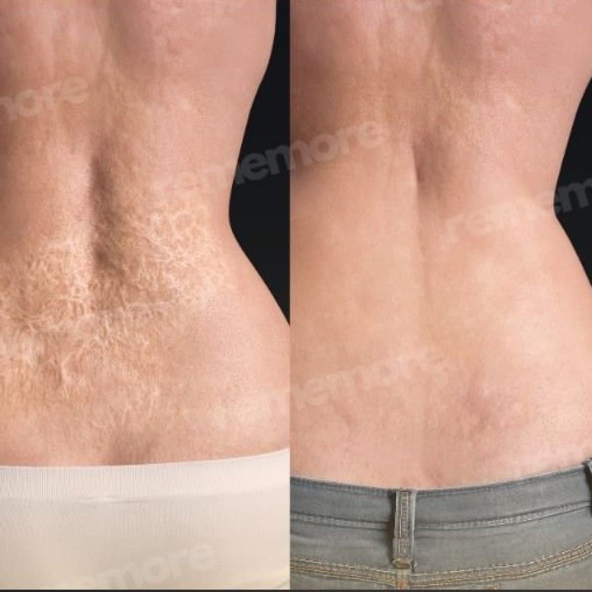 scar revision